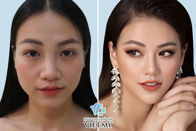 Hoa hậu Phương Khánh phẫu thuật sửa mũi và phẫu thuật thẩm mỹ toàn diện