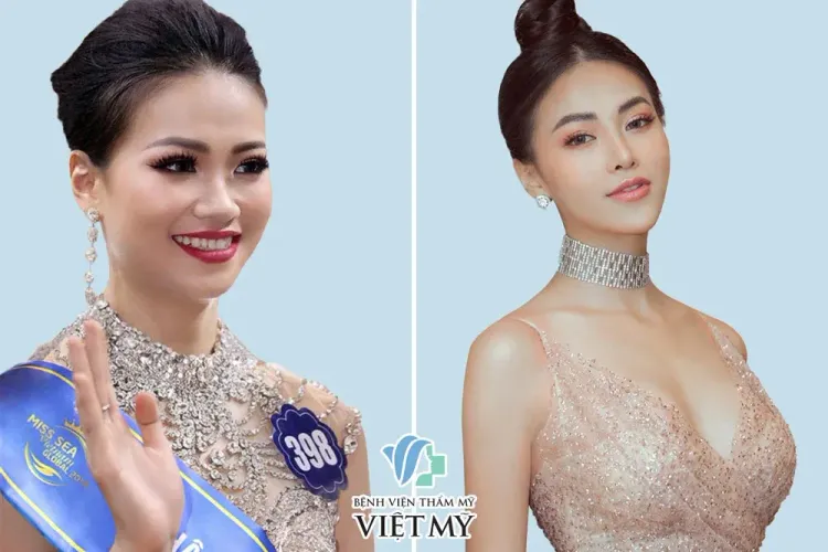 Hoa hậu Phương Khánh trước và sau nâng ngực nội soi, phẫu thuật thẩm mỹ toàn diện.
