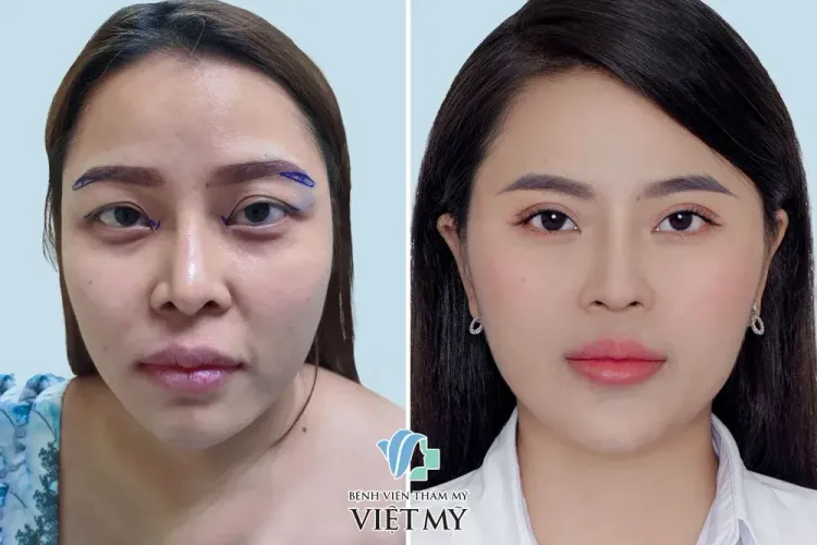 Khách hàng bị nhăn sụp đuôi mắt, mí không đều thực hiện cắt mắt, treo chân mày, mở góc mắt trong, bơm mỡ mặt, sửa mũi