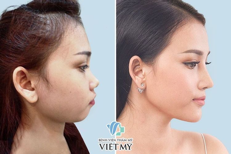 Hình ảnh khách hàng trước và sau thu gọn cánh mũi