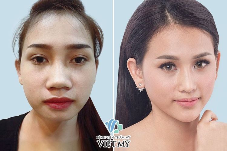 Hình ảnh khách hàng trước và sau thu gọn cánh mũi