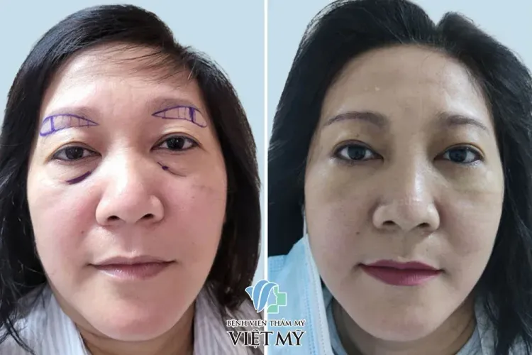 Treo chân mày và cắt mí dưới sau 5 ngày cắt chỉ.