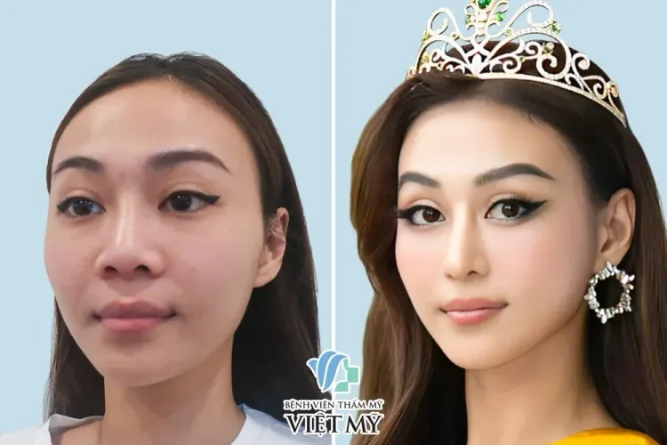 Á hậu Tuyết Như trước và sau nâng mũi