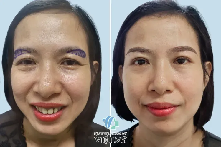Vừa mới treo chân mày và sẽ cắt chỉ sau 5 ngày.