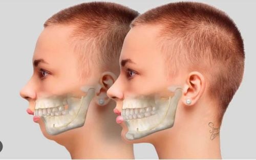 Phẫu thuật điều trị hàm hô
