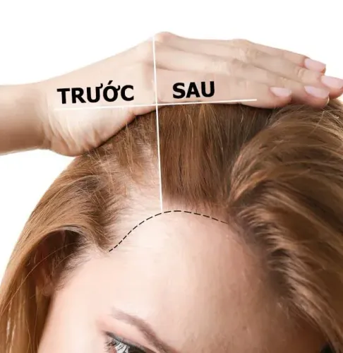 Trị rụng tóc không phẫu thuật, Tóc là cấu trúc sừng hình sợi dài, dẫn xuất của biểu bì da, bao phủ da đầu của người. Tóc có thành phần chủ yếu là chất sừng, giàu biotin, kẽm,..